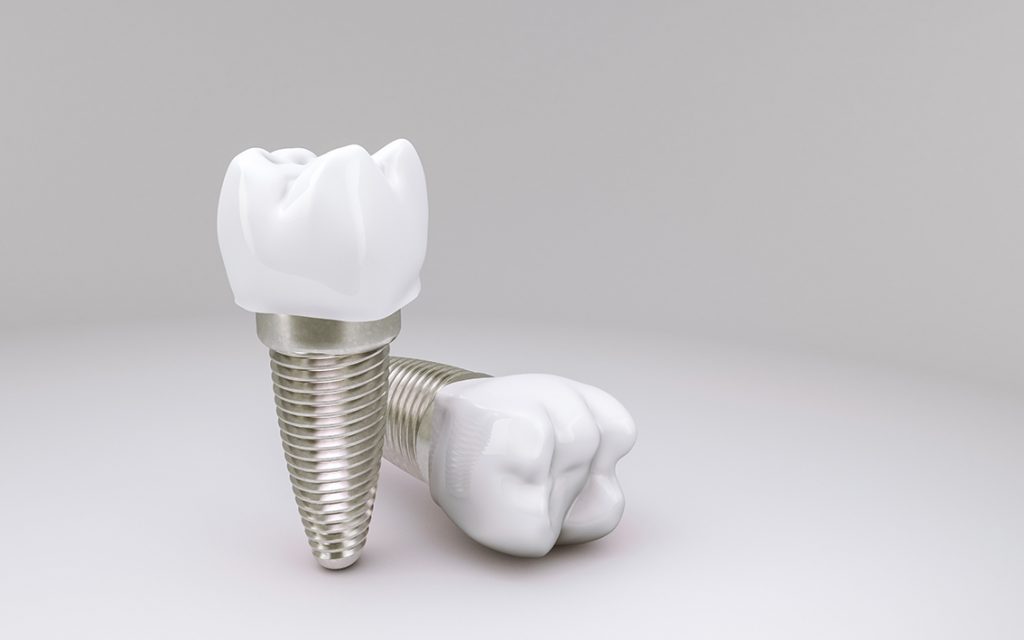 implantes-dentales-1
