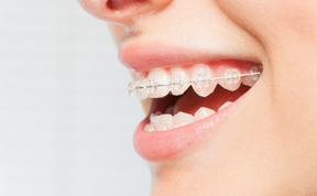 ortodoncia-vallecas-brakets-porcelana