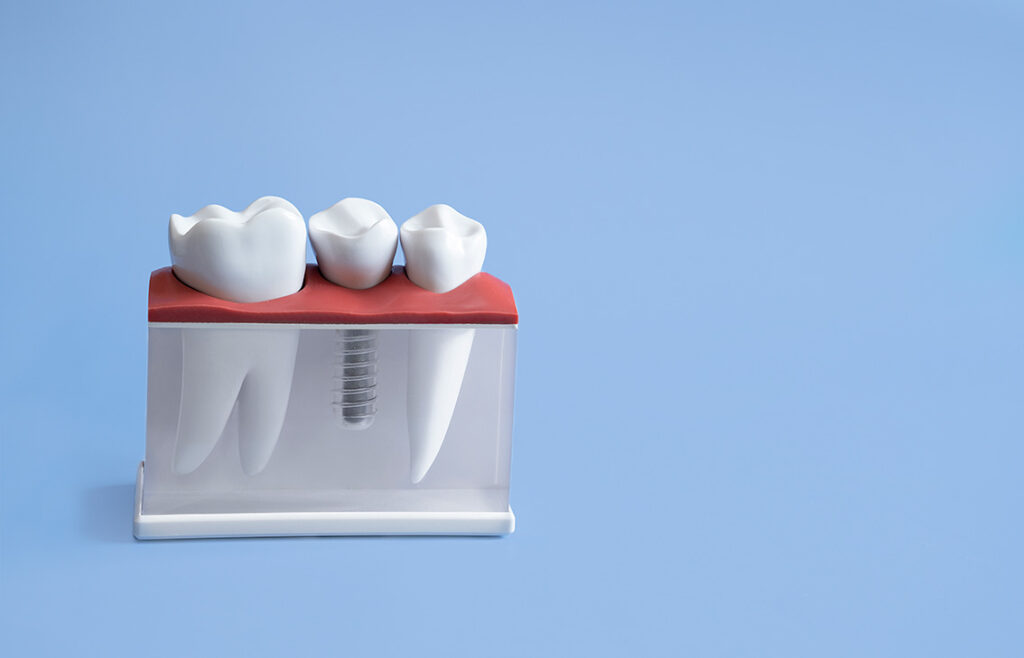 que-seguridad-aporta-implante-dental-2