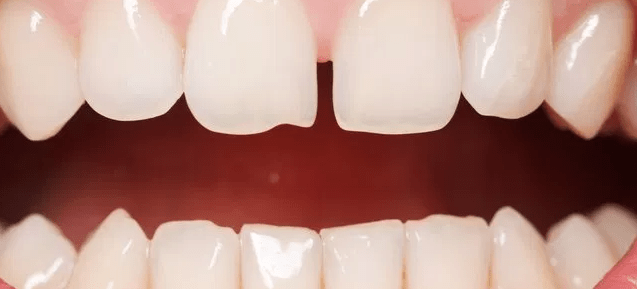 diastema-dental-2