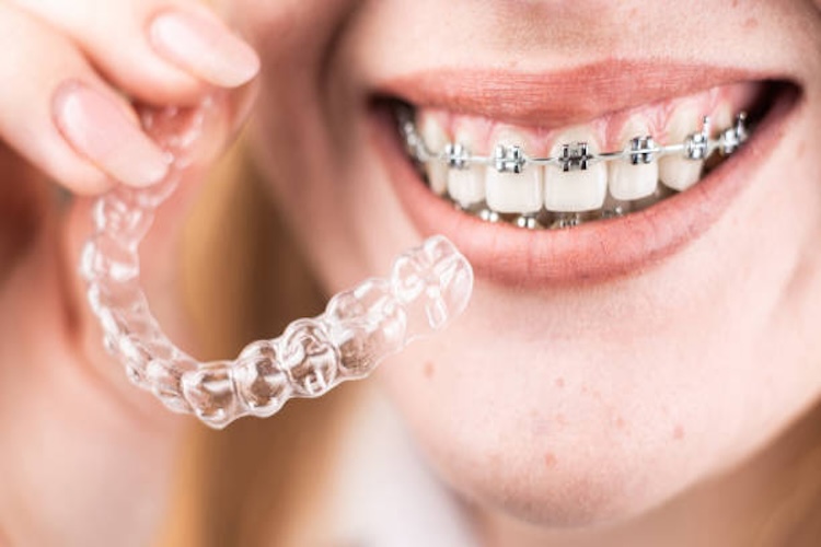 brackets vs ortodoncia invisible