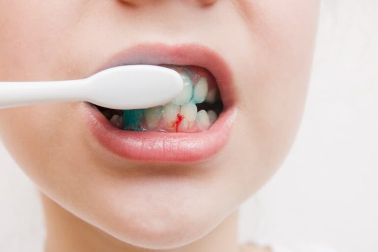sangrado-encias-clinica-dental-madrid-dentiplan